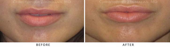 Lip augmentation Before & After Photo - Patient Seeing Straight - Patient 12