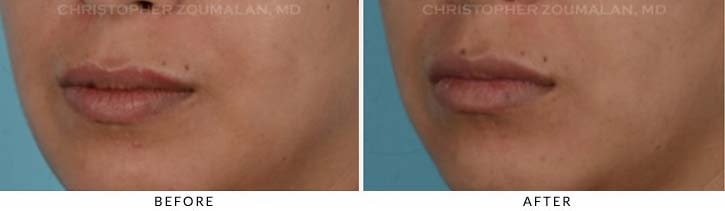 Lip augmentation Before & After Photo - Patient Seeing Side - Patient 1B