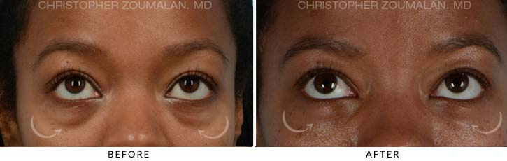 Lower Lid Blepharoplasty Before & After Photo - Patient Seeing Up - Patient 11B