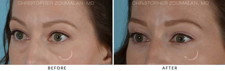 Lower Lid Blepharoplasty Before & After Photo - Patient Seeing Side - Patient 12D