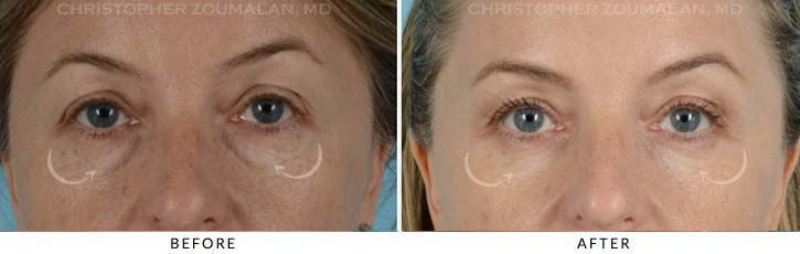 Lower Lid Blepharoplasty Before & After Photo - Patient Seeing Straight - Patient 13A