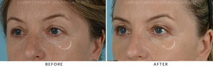 Lower Lid Blepharoplasty Before & After Photo - Patient Seeing Side - Patient 13C