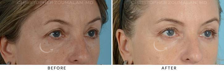 Lower Lid Blepharoplasty Before & After Photo - Patient Seeing Side - Patient 13D