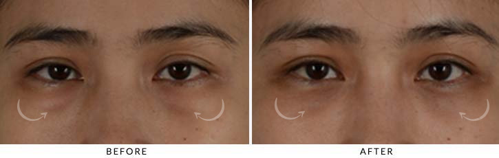 Lower Lid Blepharoplasty Before & After Photo - Patient Seeing Straight - Patient 14A