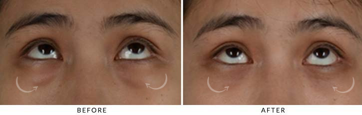 Lower Lid Blepharoplasty Before & After Photo - Patient Seeing Up - Patient 14B