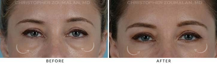 Lower Lid Blepharoplasty Before & After Photo - Patient Seeing Straight - Patient 15A