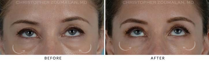 Lower Lid Blepharoplasty Before & After Photo - Patient Seeing Up - Patient 15B