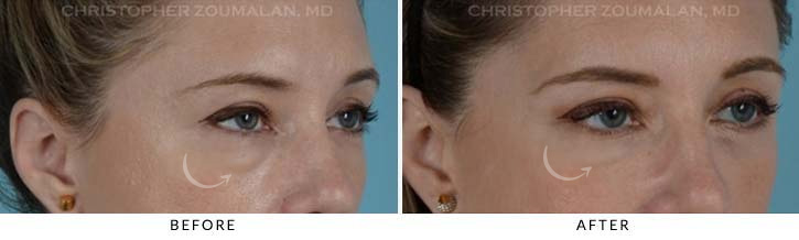 Lower Lid Blepharoplasty Before & After Photo - Patient Seeing Side - Patient 15C