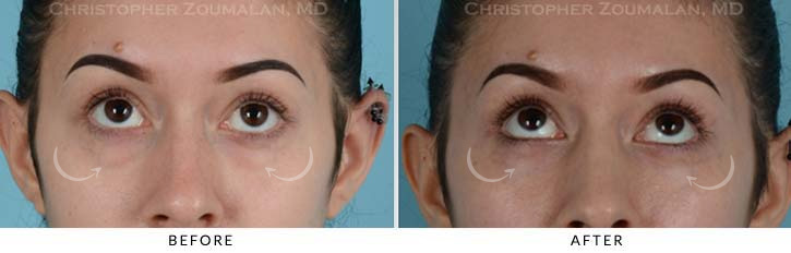 Lower Lid Blepharoplasty Before & After Photo - Patient Seeing Up - Patient 16B