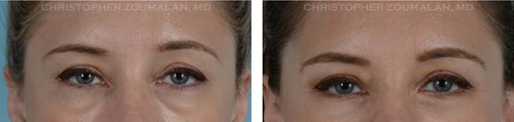 Lower Lid Blepharoplasty Front look