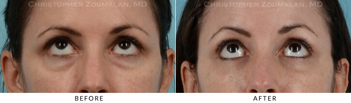 Lower Lid Blepharoplasty Before & After Photo - Patient Seeing Up - Patient 23B