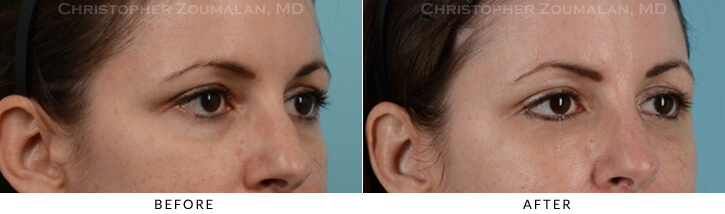 Lower Lid Blepharoplasty Before & After Photo -  - Patient 23C