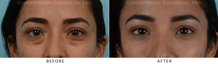 Lower Lid Blepharoplasty Before & After Photo - Patient Seeing Straight - Patient 24A