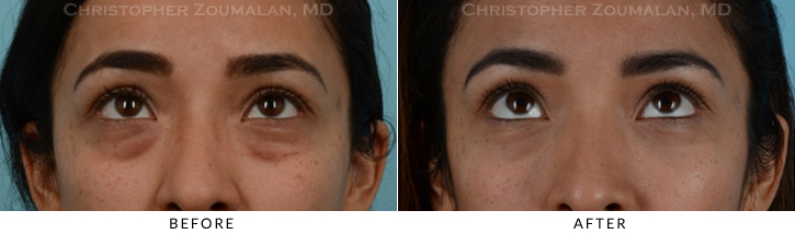 Lower Lid Blepharoplasty Before & After Photo - Patient Seeing Up - Patient 24B