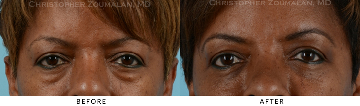 Lower Lid Blepharoplasty Before & After Photo - Patient Seeing Straight - Patient 25A