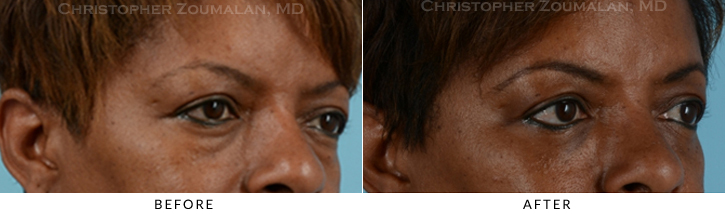 Lower Lid Blepharoplasty Before & After Photo -  - Patient 25C