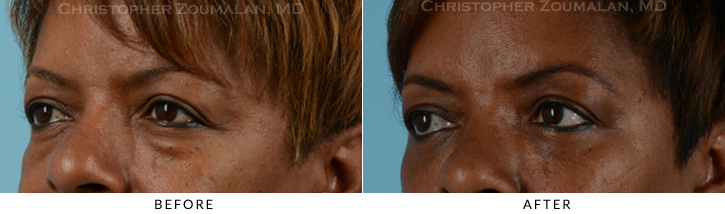 Lower Lid Blepharoplasty Before & After Photo - Patient Seeing Side - Patient 25D