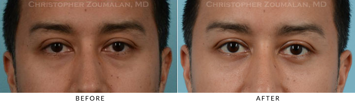 Lower Lid Blepharoplasty Before & After Photo - Patient Seeing Straight - Patient 27A