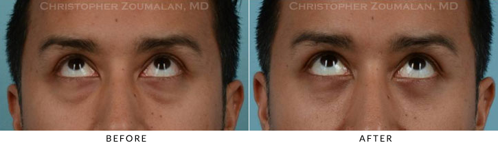 Lower Lid Blepharoplasty Before & After Photo - Patient Seeing Up - Patient 27B