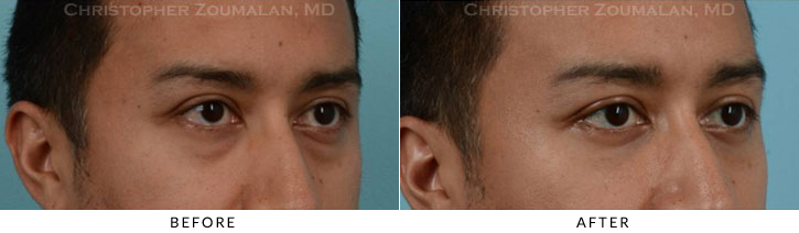 Lower Lid Blepharoplasty Before & After Photo -  - Patient 27C