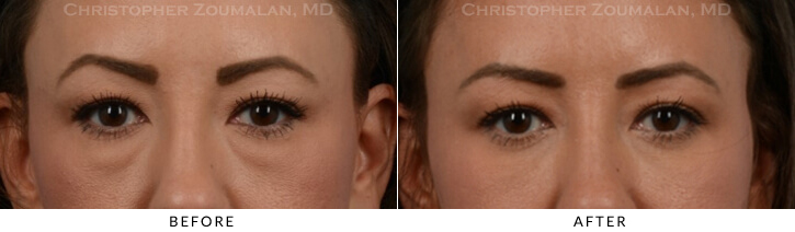 Lower Lid Blepharoplasty Before & After Photo - Patient Seeing Straight - Patient 28A