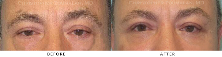 Lower Lid Blepharoplasty Before & After Photo - Patient Seeing Straight - Patient 53B