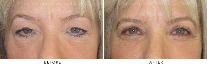 Lower Lid Blepharoplasty Before & After Photo -  - Patient 54