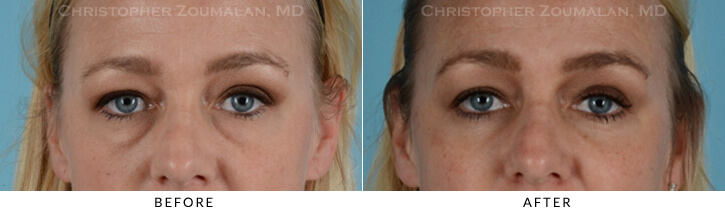 Lower Lid Blepharoplasty Before & After Photo - Patient Seeing Straight - Patient 17A