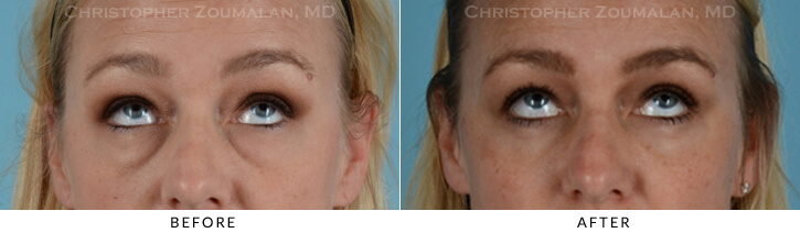 Lower Lid Blepharoplasty Before & After Photo - Patient Seeing Up - Patient 17B