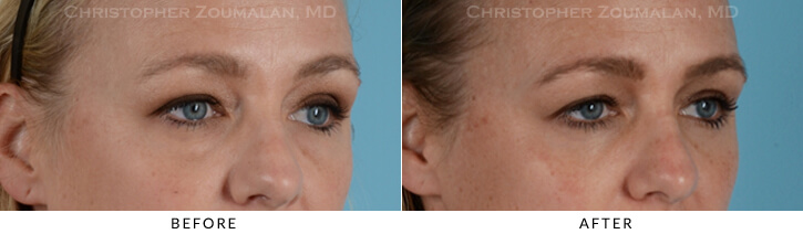 Lower Lid Blepharoplasty Before & After Photo -  - Patient 17C