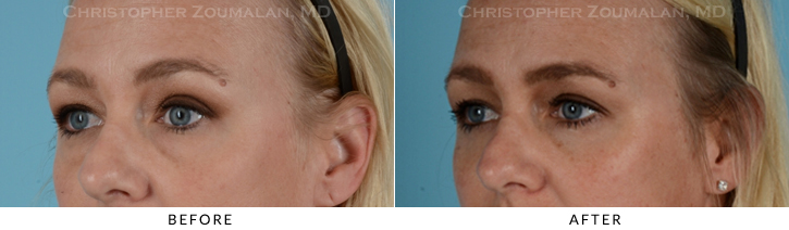 Lower Lid Blepharoplasty Before & After Photo - Patient Seeing Side - Patient 17D