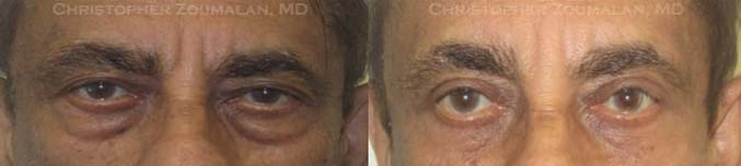 Bilateral upper lid ptosis repair, upper and lower lid blepharoplasty with fat repositioning to lower lids, and left external browpexy - male patient before and after picture