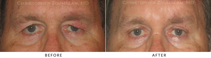 Male Blepharoplasty Before & After Photo -  - Patient 23