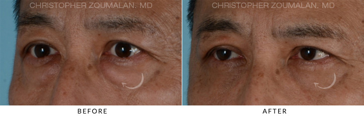 Male Blepharoplasty Before & After Photo - Patient Seeing Side - Patient 6B