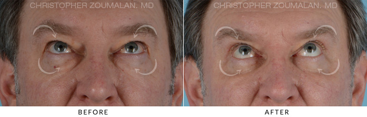 Male Blepharoplasty Before & After Photo - Patient Seeing Up - Patient 7C