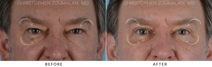 Male Blepharoplasty Before & After Photo - Patient Seeing Straight - Patient 7D