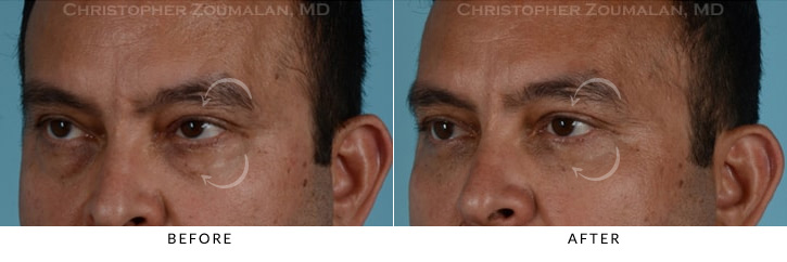 Male Blepharoplasty Before & After Photo - Patient Seeing Side - Patient 11C