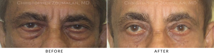 Male Brow Lift Before & After Photo -  - Patient 14