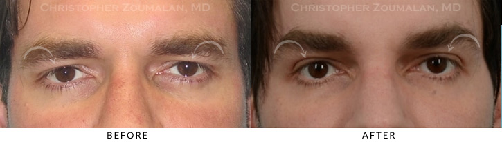 Male Brow Lift Before & After Photo -  - Patient 2