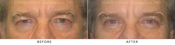 Male Brow Lift Before & After Photo -  - Patient 4