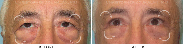 Male Brow Lift Before & After Photo - Patient Seeing Straight - Patient 6A