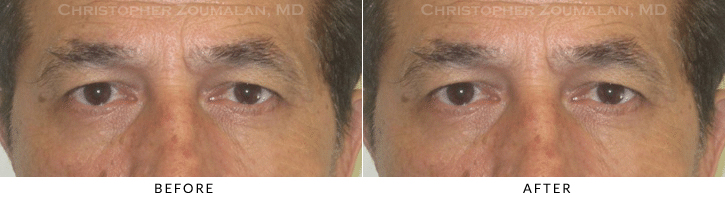 Male Brow Lift Before & After Photo -  - Patient 9