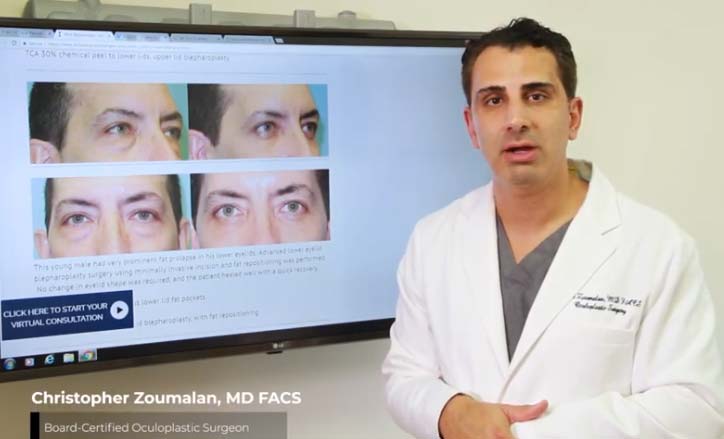 Male Blepharoplasty Video