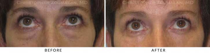 Midface Lift Before & After Photo - Patient Seeing Up - Patient 1B