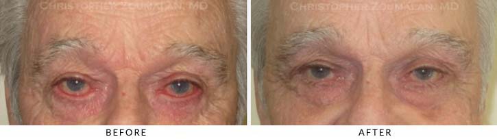 Midface Lift Before & After Photo - Patient Seeing Straight - Patient 3