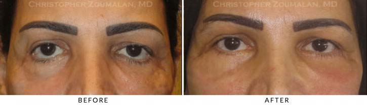 Midface Lift Before & After Photo - Patient Seeing Straight - Patient 4