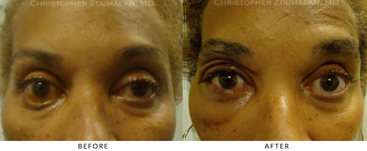 Midface Lift Before & After Photo - Patient Seeing Straight - Patient 5