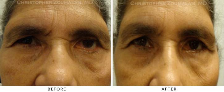 Midface Lift Before & After Photo - Patient Seeing Straight - Patient 6