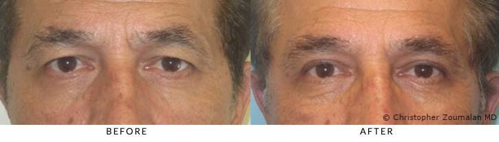 Bilateral upper lid ptosis repair (blepharoplasty) and external browpexy - male patient before and after picture