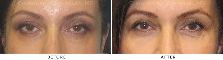 Ptosis Surgery Before & After Photo -  - Patient 14